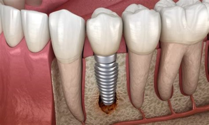 Are tooth implants painful?