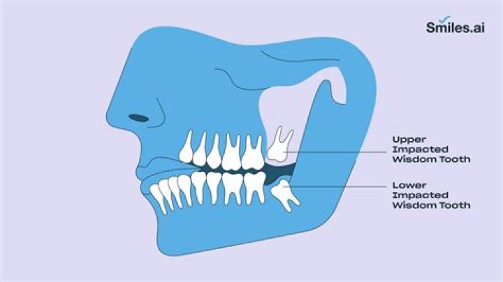 Are top teeth easier to extract?