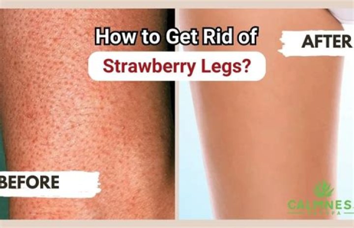 Can a dermatologist help with strawberry legs?