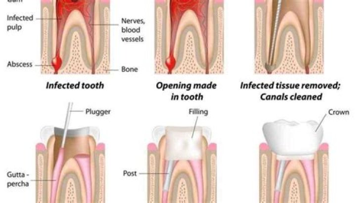 Can a tooth with a root canal hurt years later?