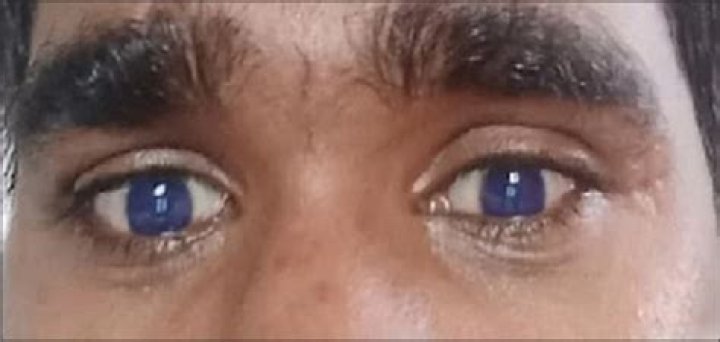 Can brown eyes turn blue?