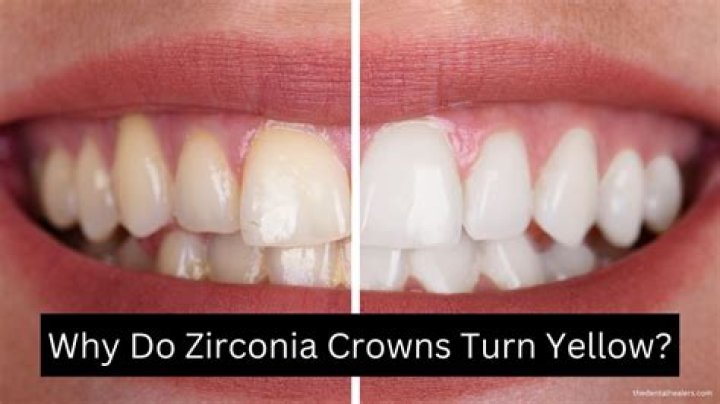 Can crowns turn yellow?
