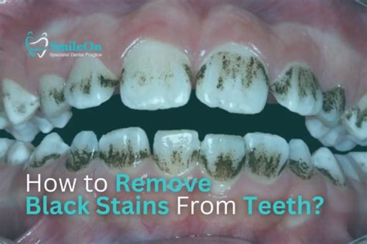 Can dentist remove brown stains?