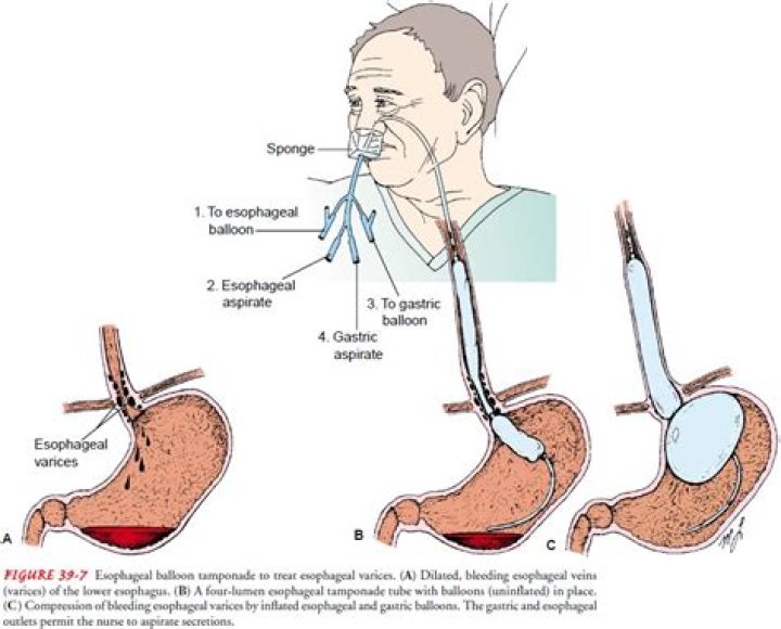 Can esophageal varices be reversed?