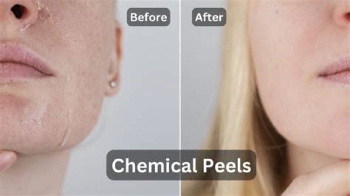 Can I do chemical peel at home?