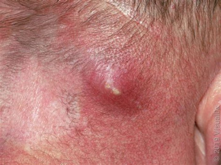 Can I pop an abscess with a needle?