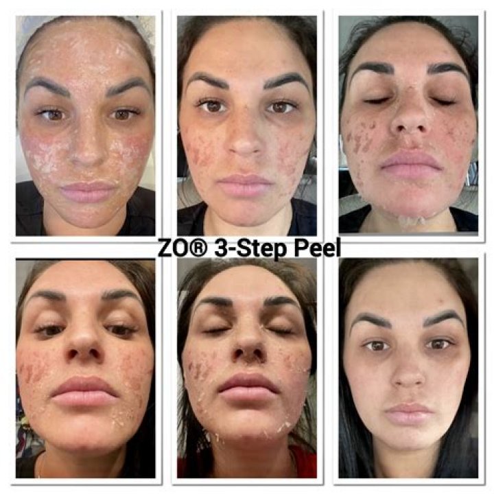 Can I rub lemon peel on my face?