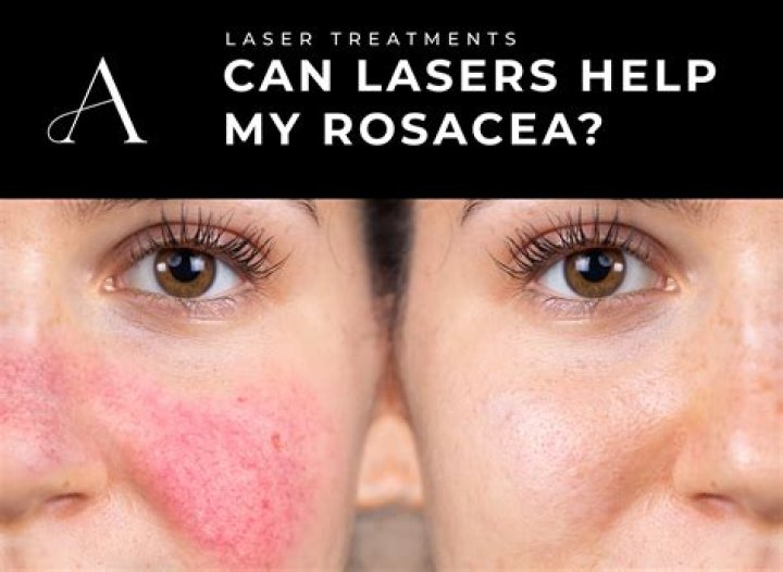 Can losing weight help rosacea?