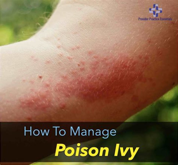 Can poison ivy make you tired?