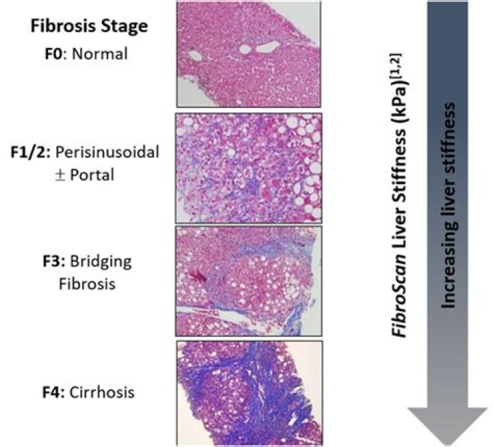 Can skin fibrosis be reversed?