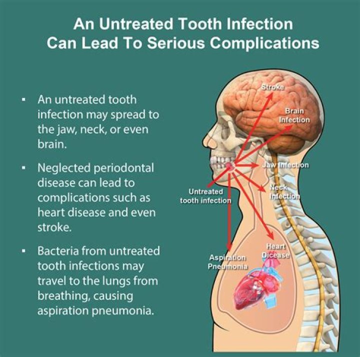 Can tooth infection spread to heart?