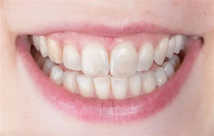 Can translucent teeth be fixed?