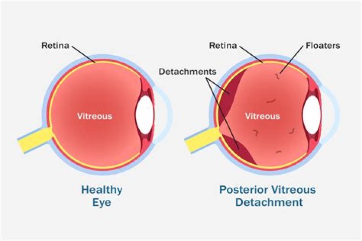 Can vitreous detachment heal itself?