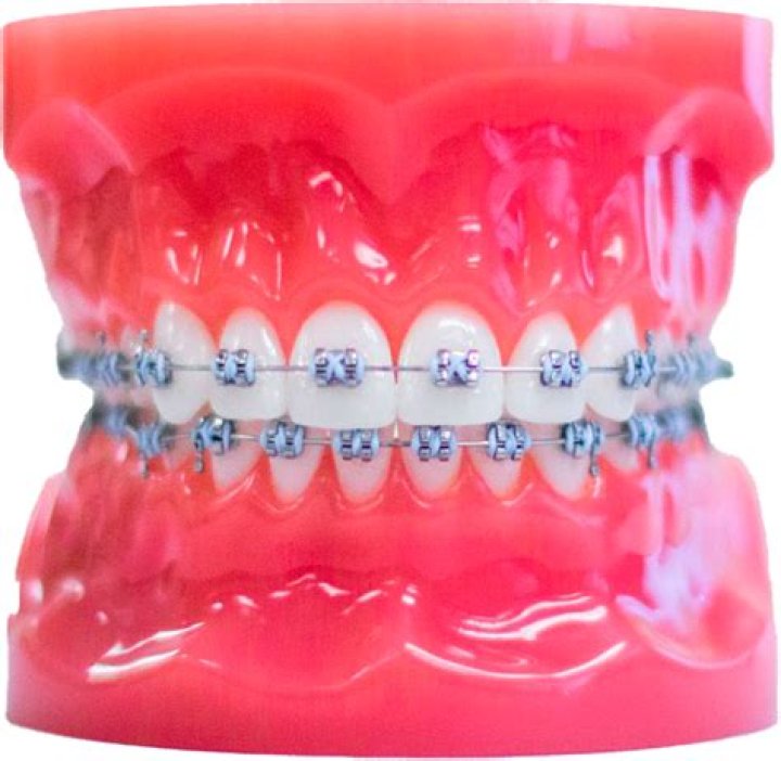 Can you get an MRI if you have braces?