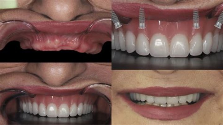 Can you get dental implants while on chemo?