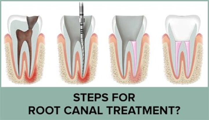 Can you have root canal treatment twice?