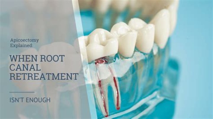 Can you request laughing gas for a root canal?