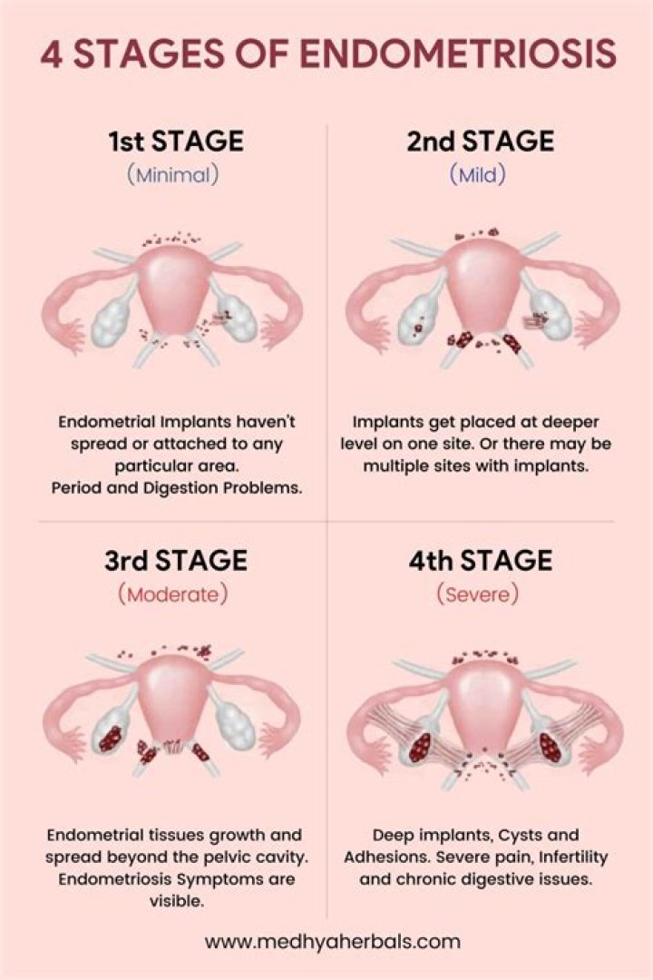 Can you suddenly develop endometriosis?