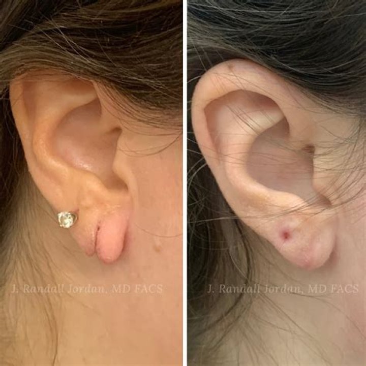 Can you super glue a ripped earlobe?
