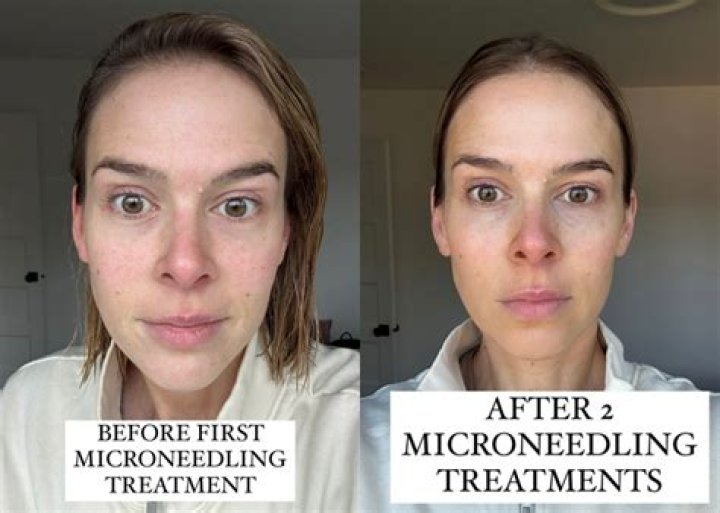 Can you wear makeup 24 hours after microneedling?