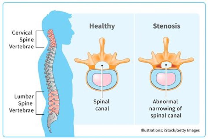 Can you work if you have spinal stenosis?