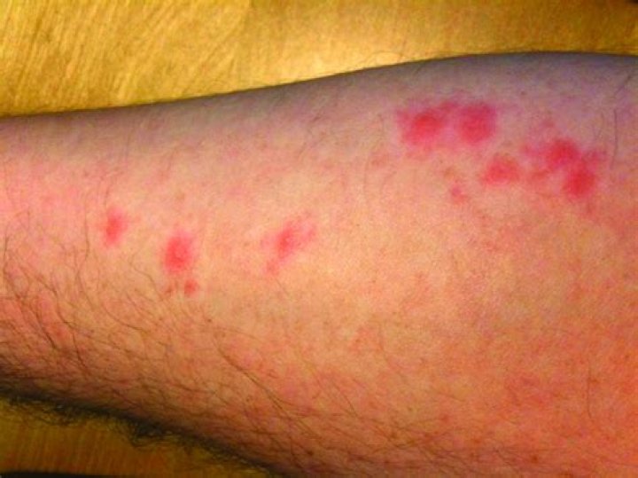 Do bed bugs bite on the legs?