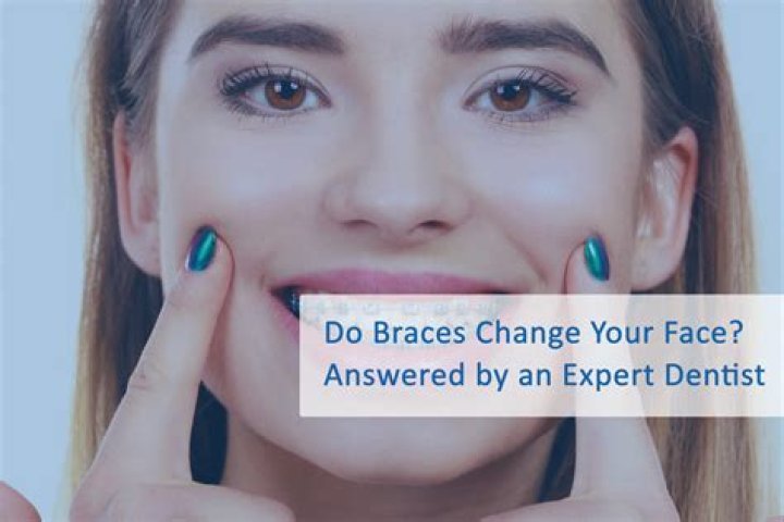 Do braces change nose shape?