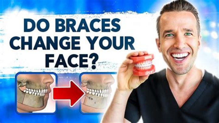 Do braces change your nose?