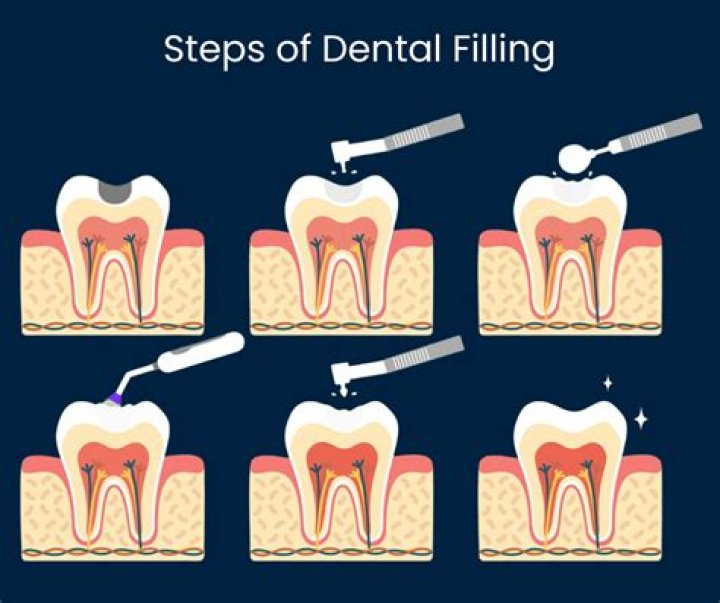 Do dentists file teeth?