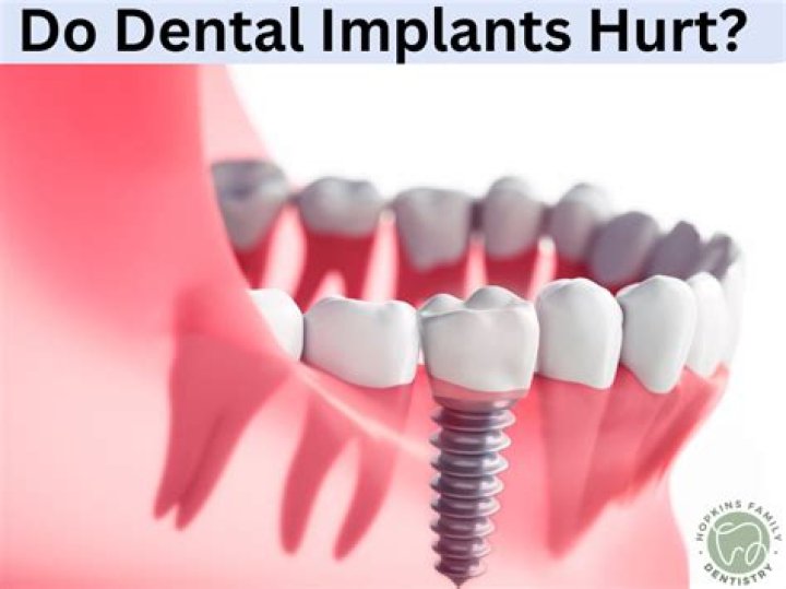 Do tooth implants hurt?