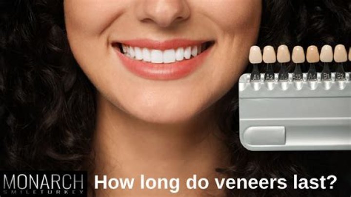 Do veneers last forever?