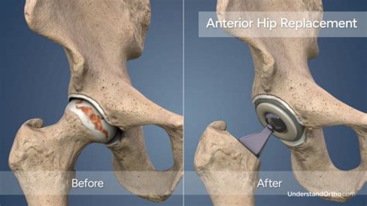Do you get a card after hip replacement?