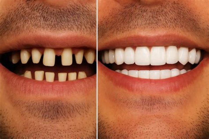 Do your teeth explode when cremated?