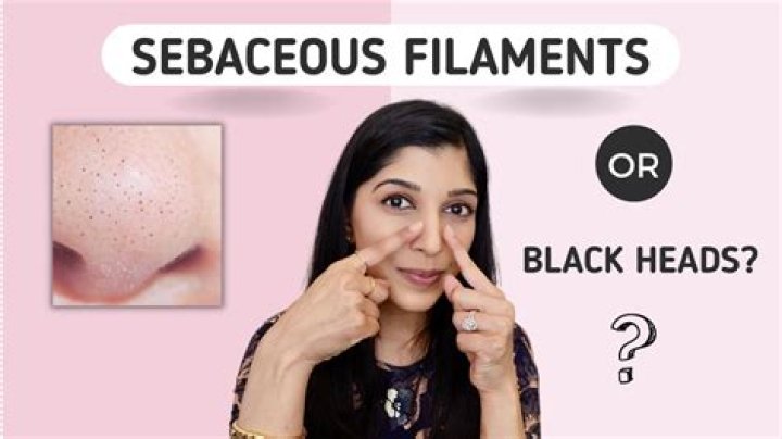 Does baking soda get rid of sebaceous filaments?