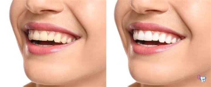 Does chewing gum whiten teeth?