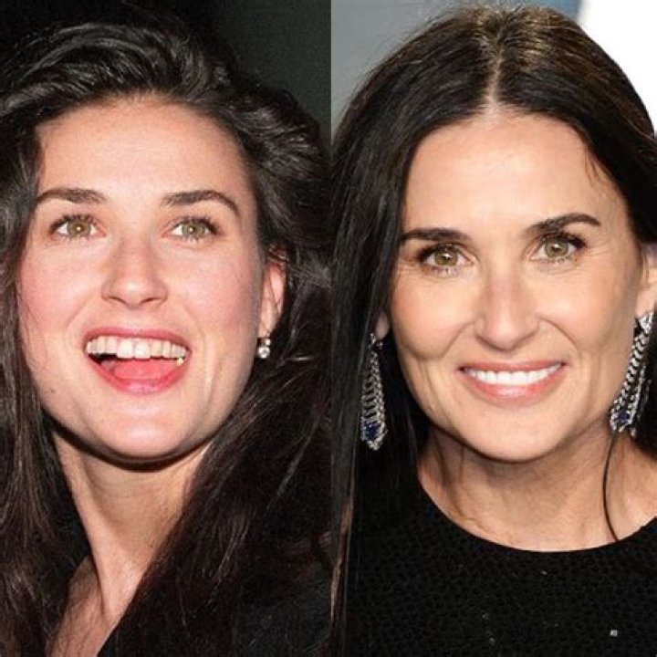 Does Demi Moore wear dentures?