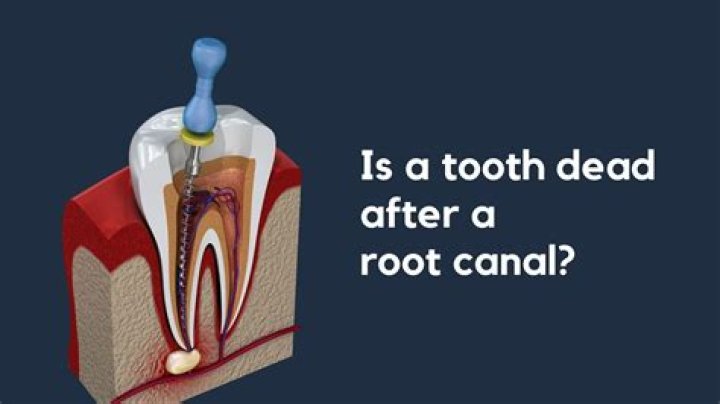 Does it hurt to talk after a root canal?