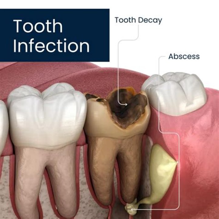 Does mouthwash help tooth infection?
