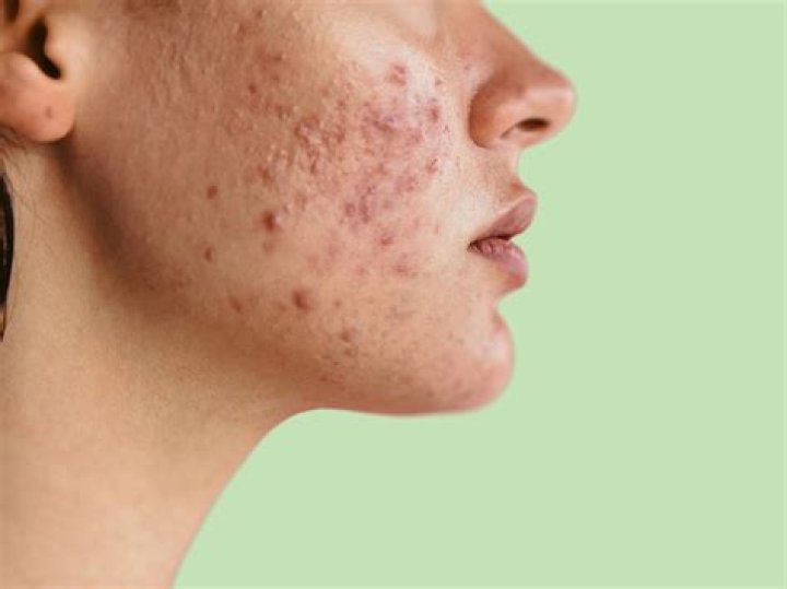 Does oatmeal cause acne?