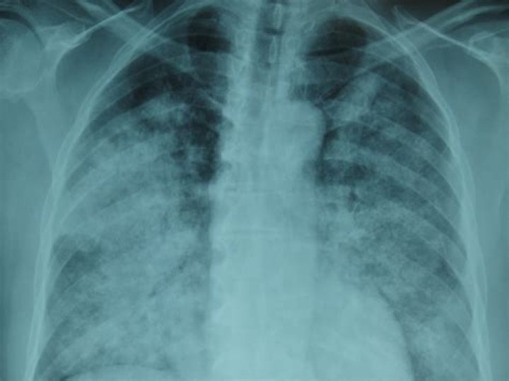 Does Serratia marcescens cause pneumonia?
