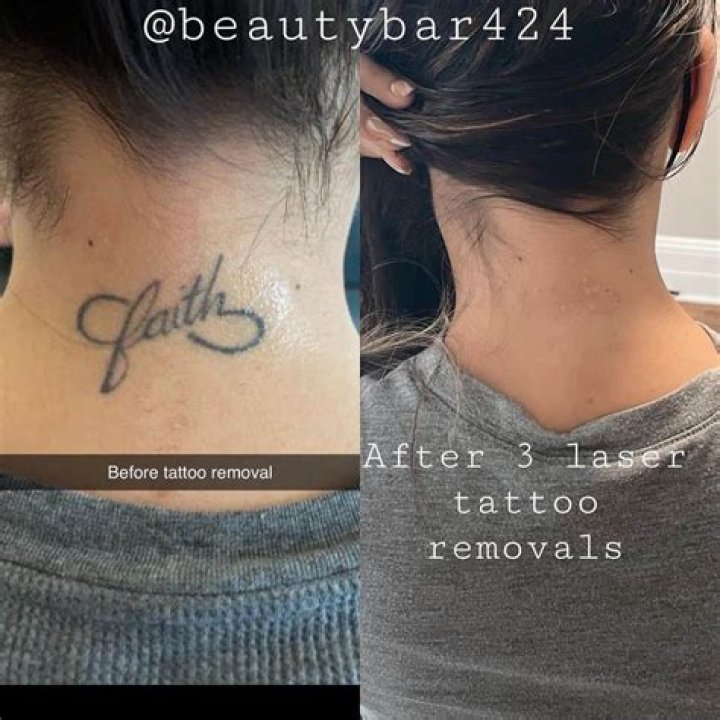 Does tattoo removal leave scars?