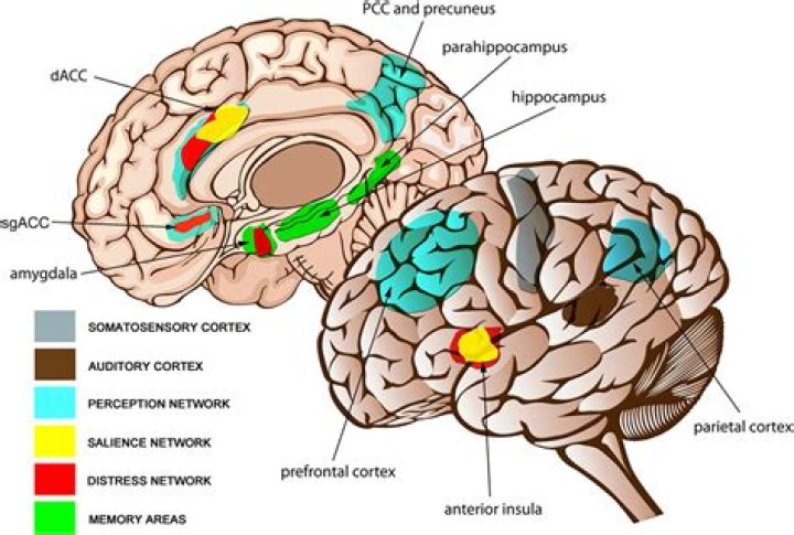 Does tinnitus affect brain?