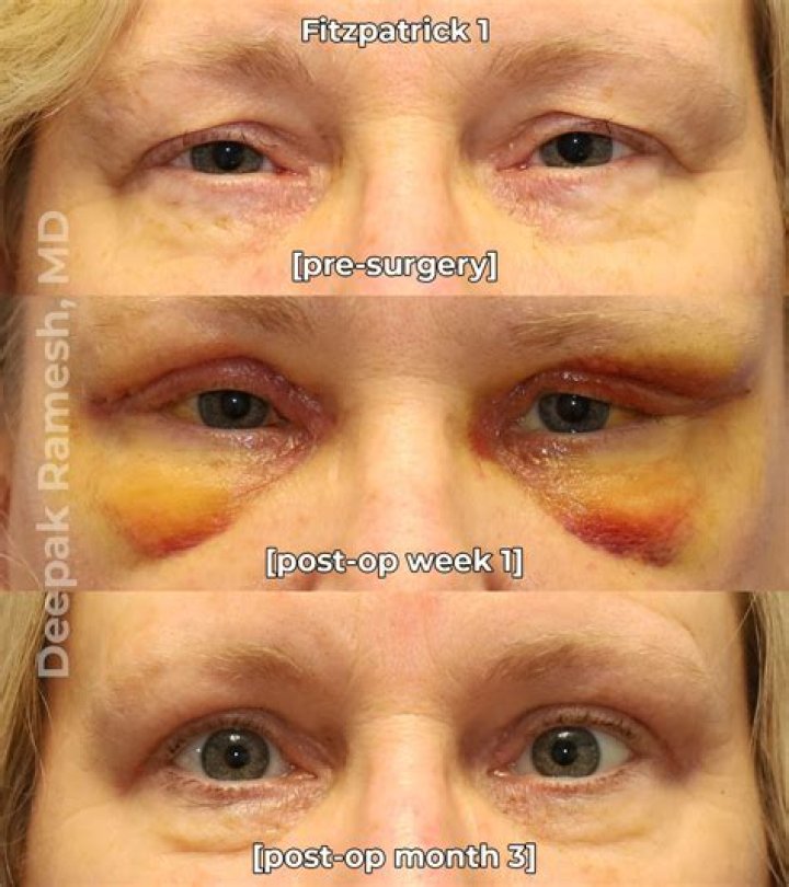 Does upper blepharoplasty change shape?
