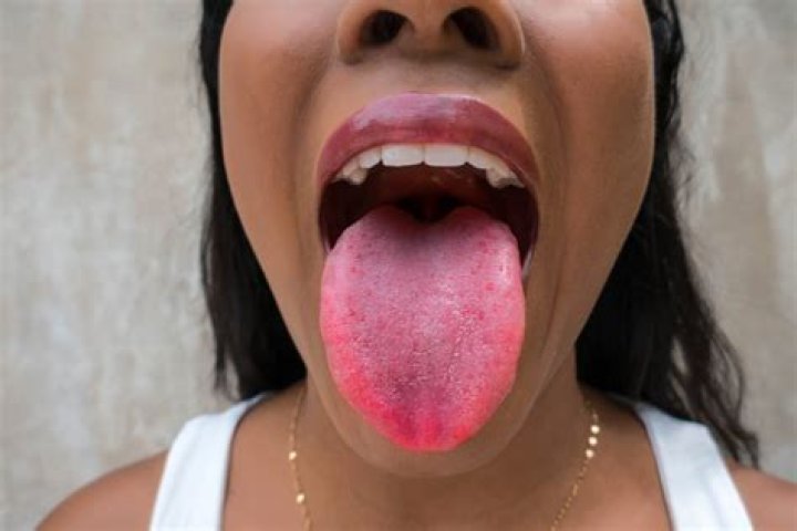 Does your tongue look weird with Covid?