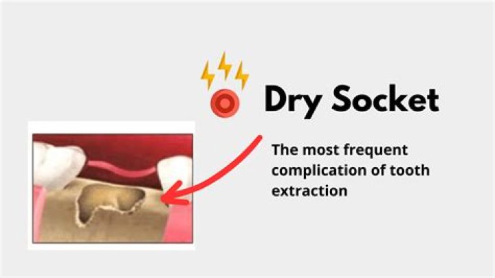 How can I fix a dry socket at home?