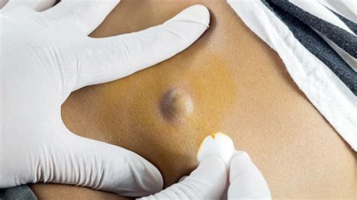 How can I make my cyst go away?