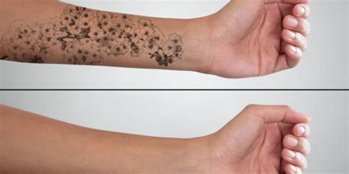 How can I remove my permanent tattoo without laser?