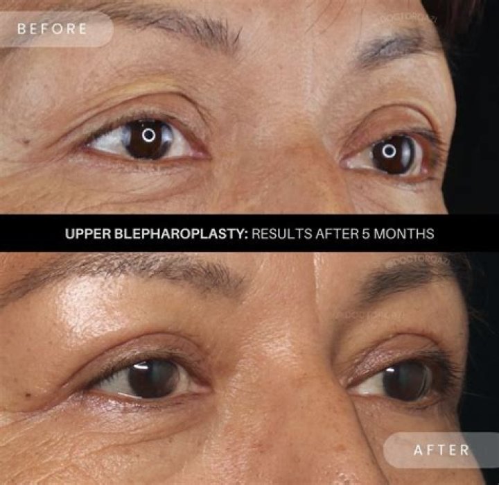 How can I tighten my upper eyelids without surgery?