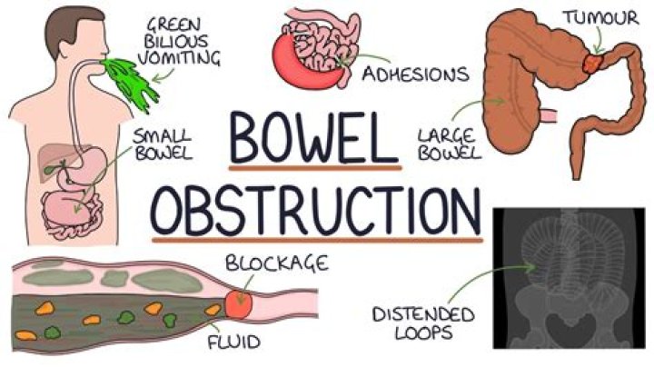 How do I know if I have a blocked bowel?
