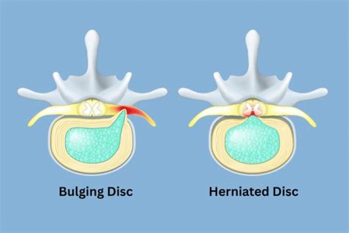 How do you fix a herniated disc without surgery?
